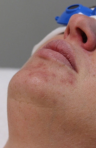 Custom Acne Regimen Before & After