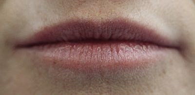 Lip Filler Before & After