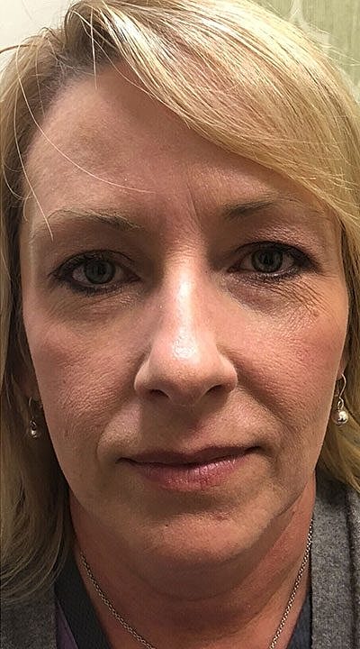 Tear Trough Filler Before & After