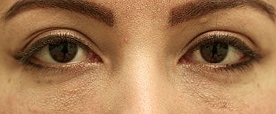 Tear Trough Filler Before & After