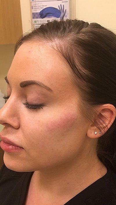 Cheek Filler Before & After