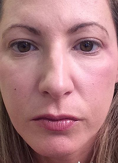 Fillers Before & After