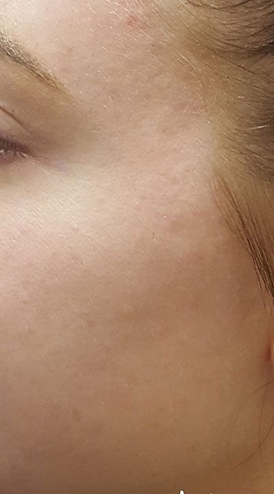 Fillers Before & After