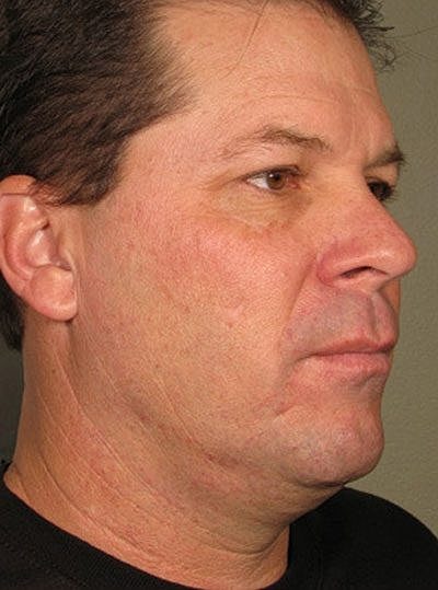 Ultherapy Before & After