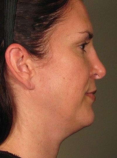 Ultherapy Before & After