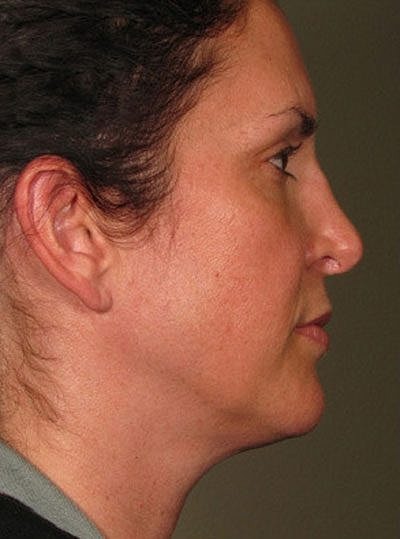 Ultherapy Before & After