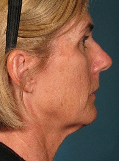 Ultherapy Before & After