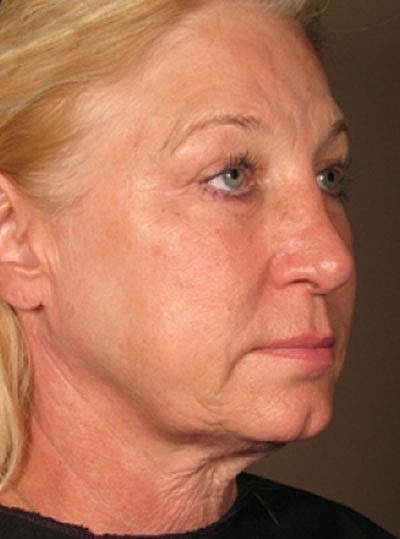 Ultherapy Before & After