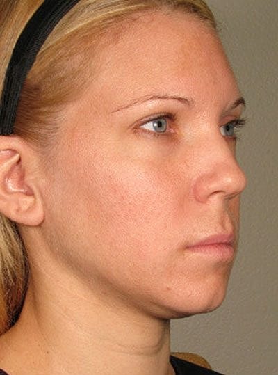 Ultherapy Before & After