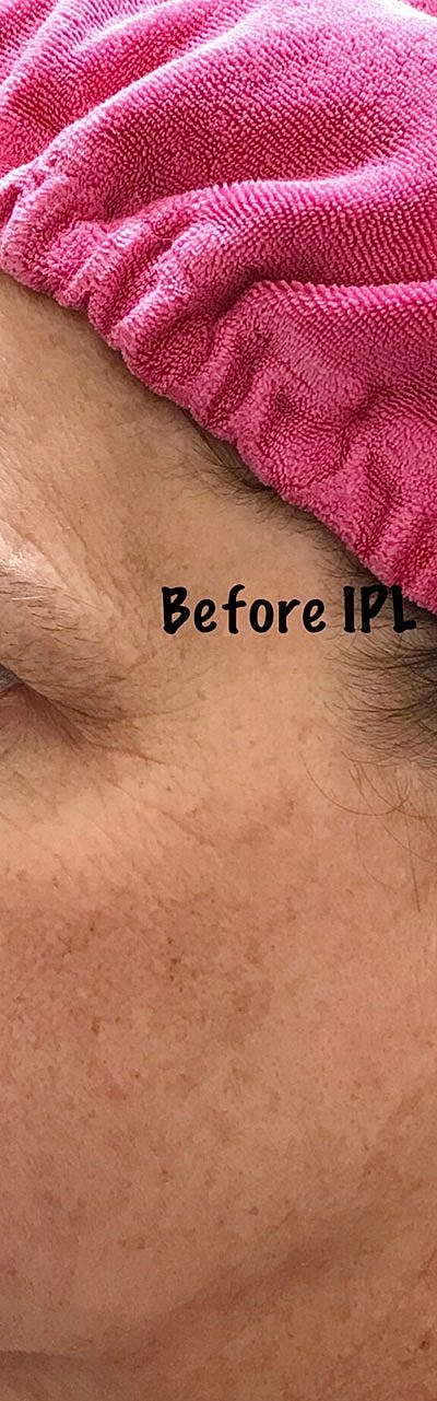Ipl Laser Before & After