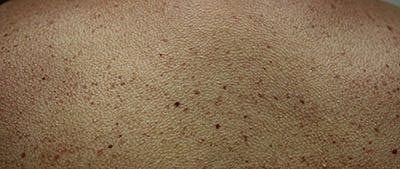 Ipl Laser Before & After