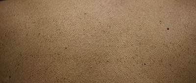 Ipl Laser Before & After