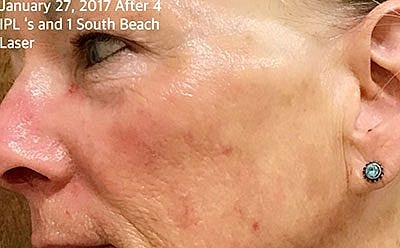 Ipl Laser Before & After