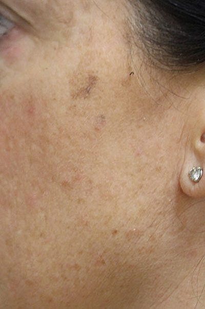 Ipl Laser Before & After