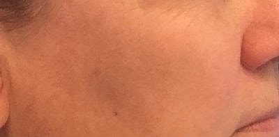 Ipl Laser Before & After