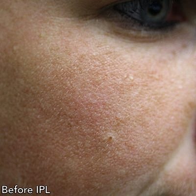 Ipl Laser Before & After
