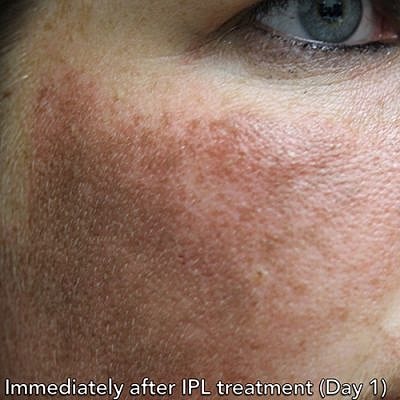 Ipl Laser Before & After