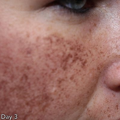 Ipl Laser Before & After