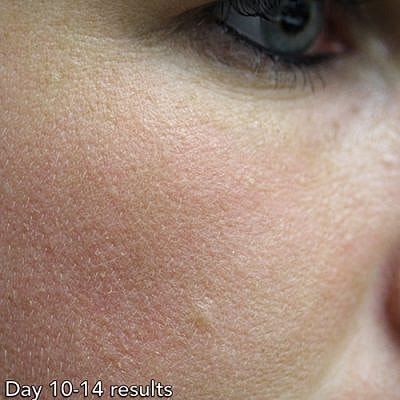 Ipl Laser Before & After