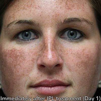 Ipl Laser Before & After