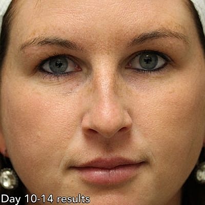 Ipl Laser Before & After