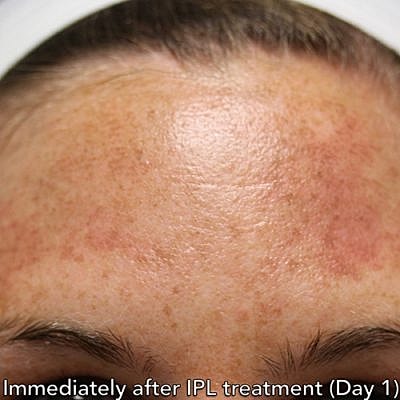Ipl Laser Before & After