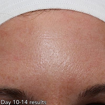 Ipl Laser Before & After