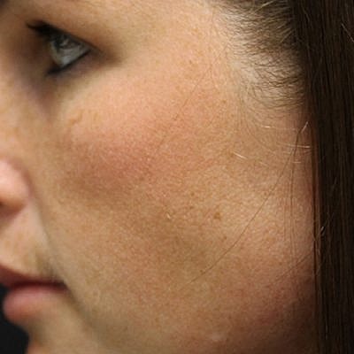 IPL Laser Before & After