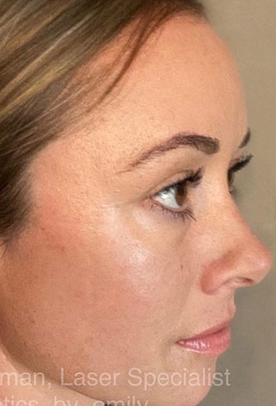 Ipl Laser Before & After