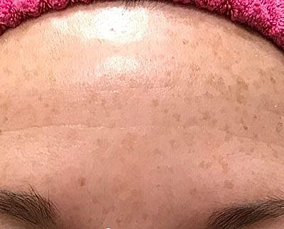 Ipl Laser Before & After