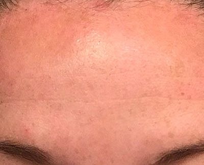 Ipl Laser Before & After