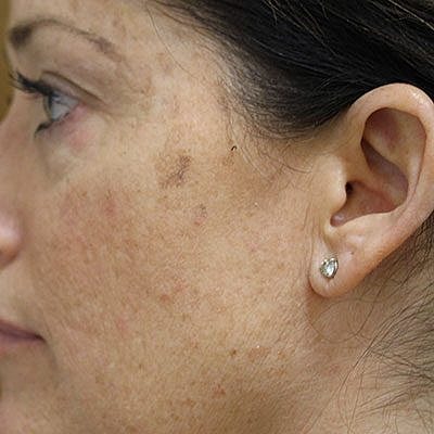 Ipl Laser Before & After