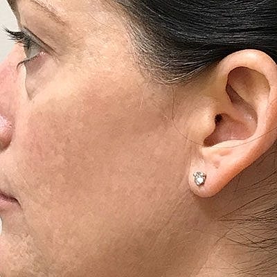 Ipl Laser Before & After