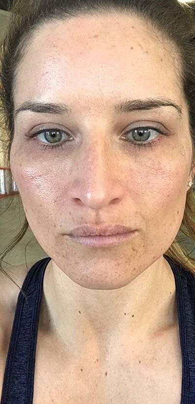 Ipl Laser Before & After