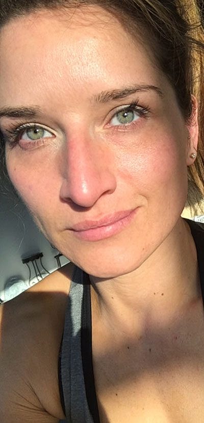 Ipl Laser Before & After