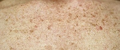 Ipl Laser Before & After