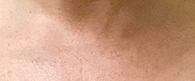 Ipl Laser Before & After