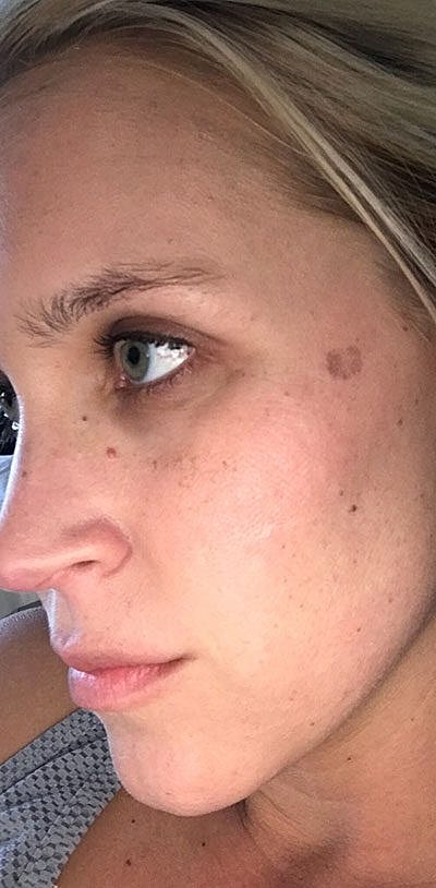 Ipl Laser Before & After