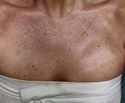 Ipl Laser Before & After