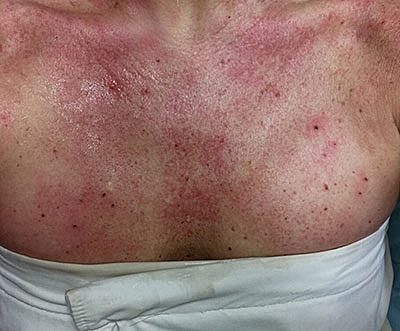 Ipl Laser Before & After