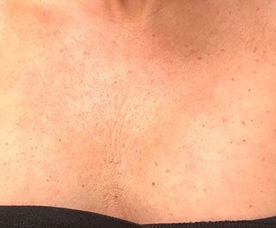 Ipl Laser Before & After