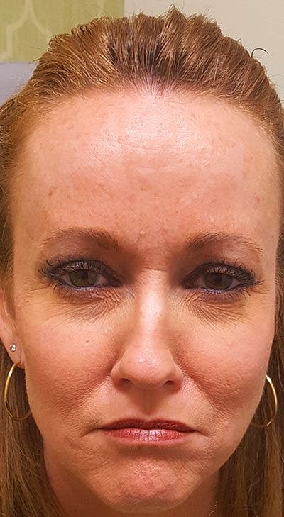 Botox Before & After