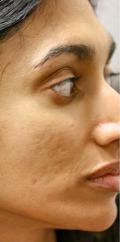 Microneedling Before & After