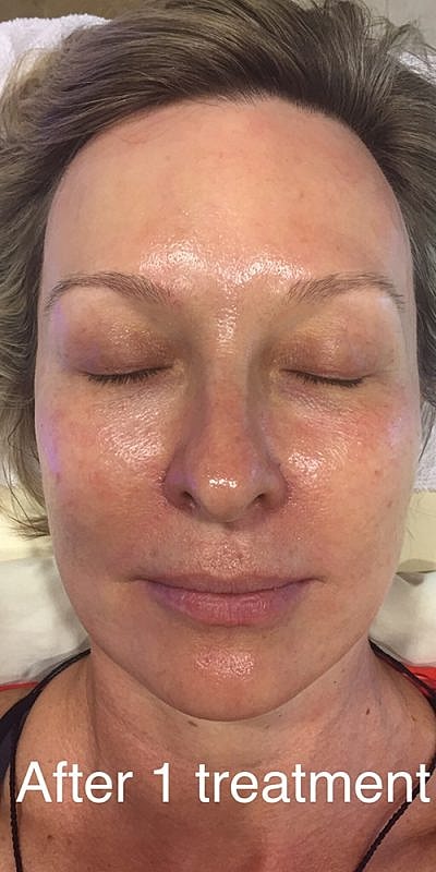 Face after skincare treatment, eyes closed.